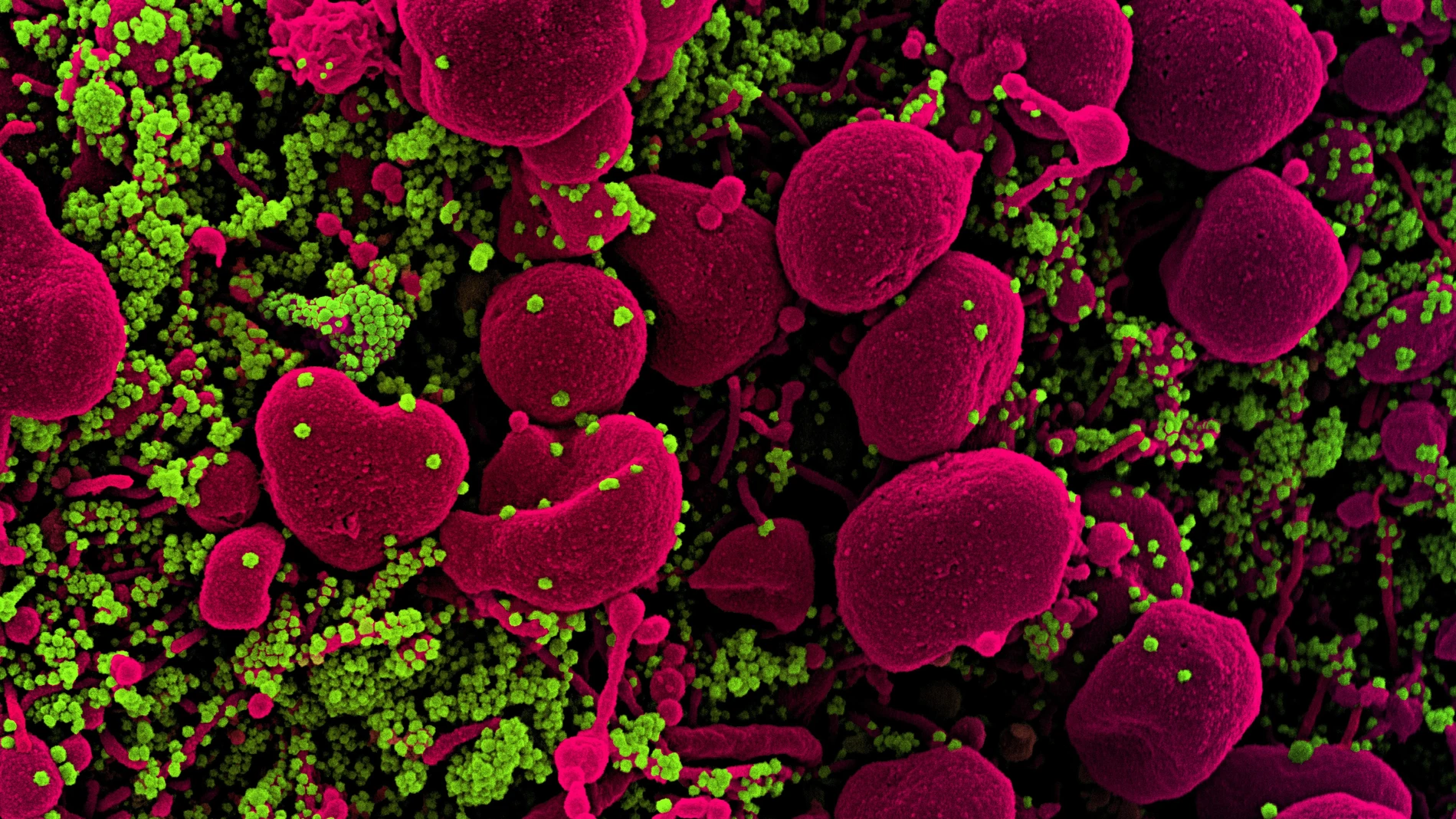 Micrografía electrónica de barrido coloreada de una célula apoptótica (rosa) muy infectada con partículas del virus SARS-COV-2 (verde), aislada de una muestra de un paciente