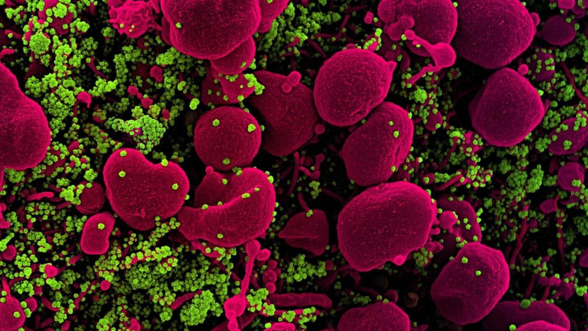 Micrografía electrónica de barrido coloreada de una célula apoptótica (rosa) muy infectada con partículas del virus SARS-COV-2 (verde), aislada de una muestra de un paciente.NATIONAL INSTITUTE OF ALLERGY 28/12/2020