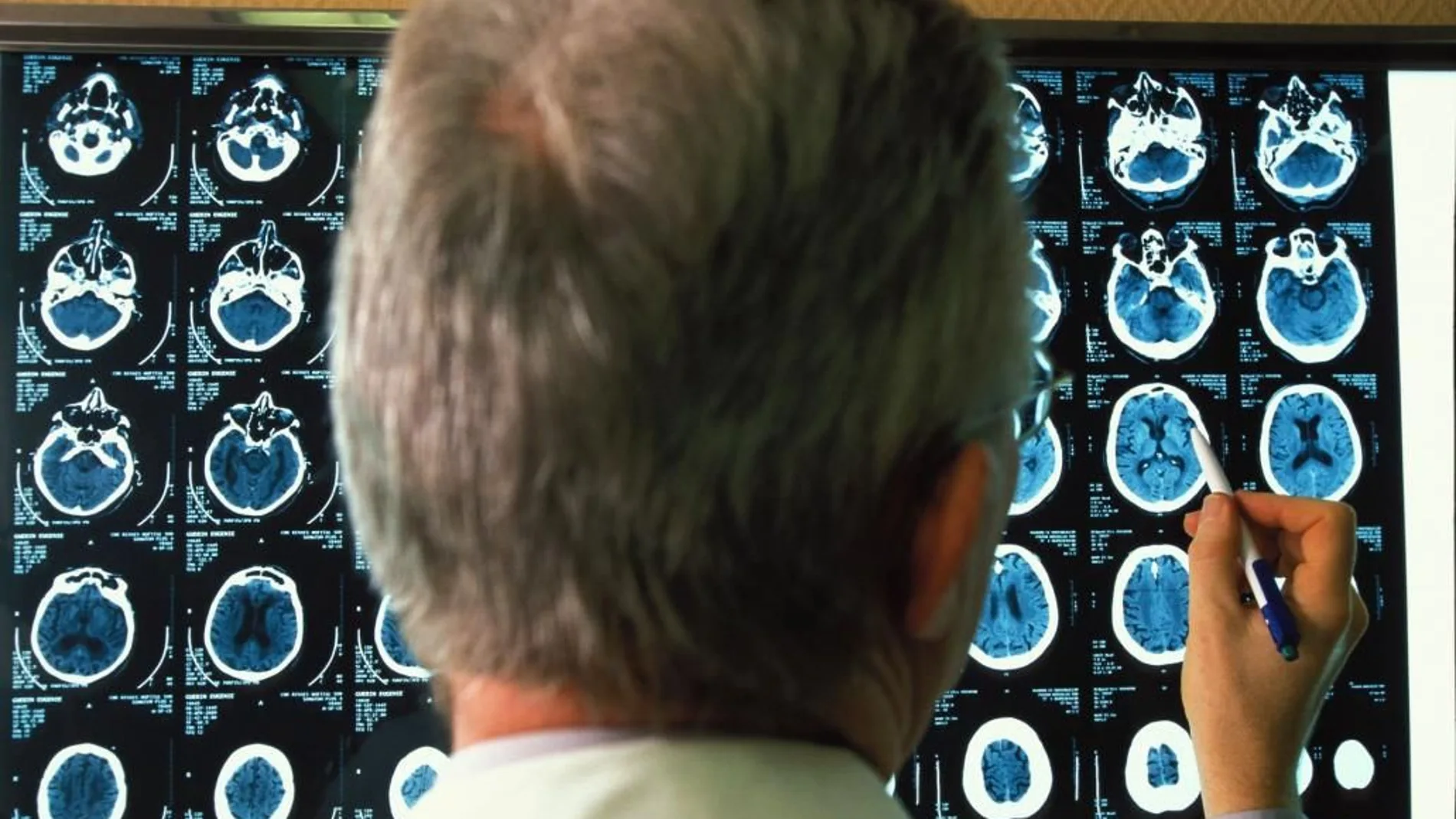 Un Doctor mira la radiografía de un derrame cerebral