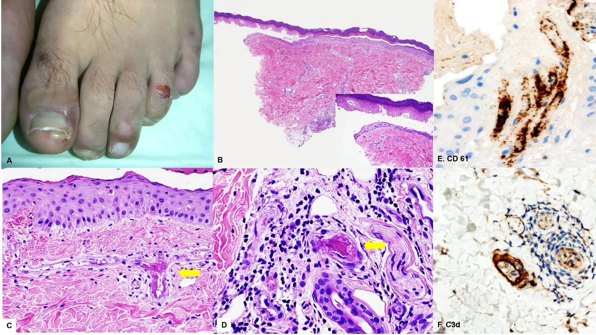 Determinadas lesiones en la piel pueden considerarse como las primeras manifestaciones de Covid-19 aunque no presenten sintomatología del SARS-CoV-2