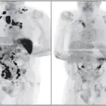 Comparación de la tomografía al inicio (izquierda) y después de meses infectado con SARS-CoV-2 (derecha)
