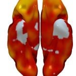 Reconstrucción tridimensional cerebral inferior donde se muestran aquellas regiones cerebrales con un menor metabolismo cerebral asociado con una mayor carga de placa en las carótidas. EFE/ CNIC