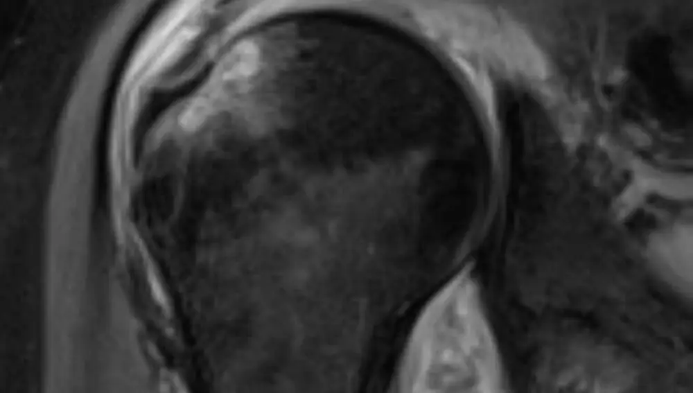 Resonancia magnética de hombro post-COVID