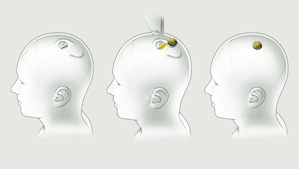 Así será el proceso de inserción de Neuralink en una cabeza humana