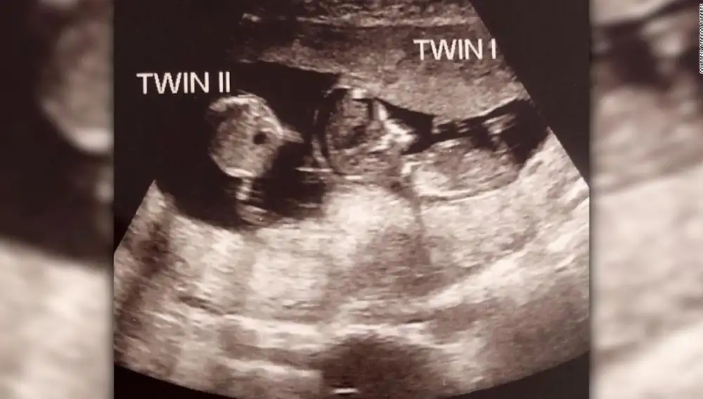 Ecografía en el que se ve a dos embriones en el vientre de Rebecca Roberts