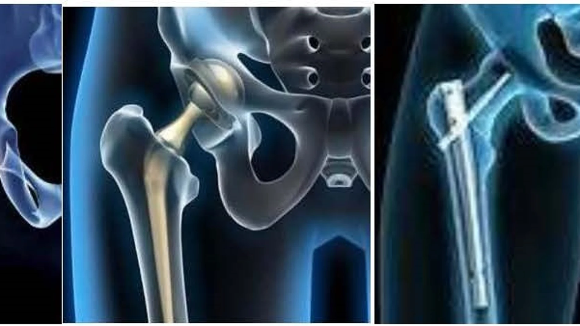 La cirugía precoz aumenta el éxito en pacientes con fractura de cadera
