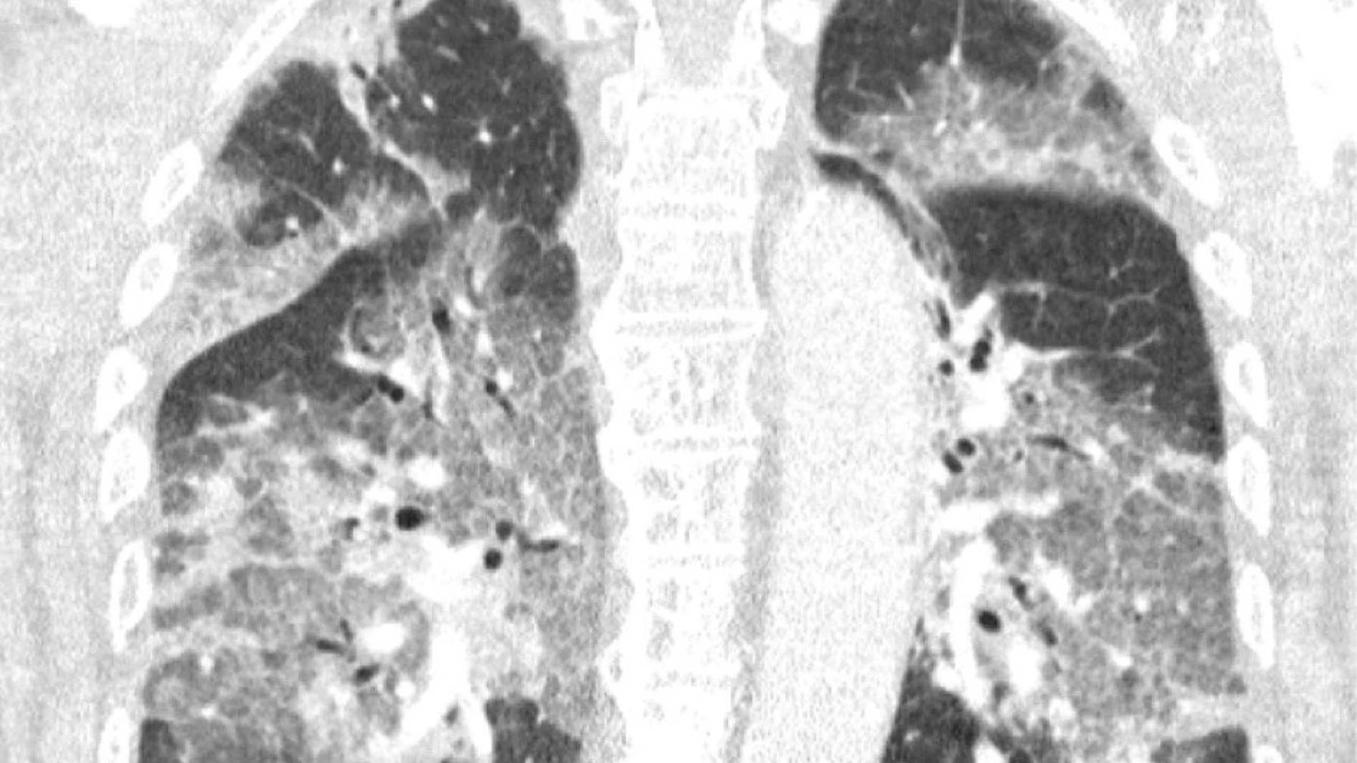 Escáner de los pulmones de un paciente de La Haya con covid