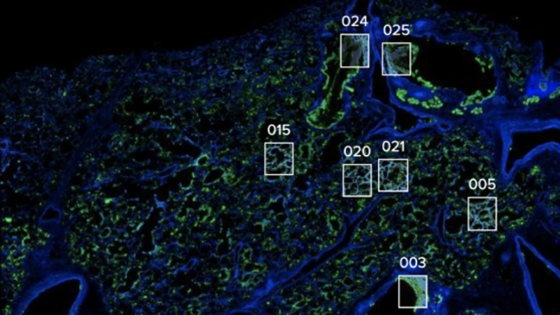 Los investigadores analizaron el tejido pulmonar de pacientes fallecidos de COVID-19 y se centraron en regiones y estructuras clave de interés