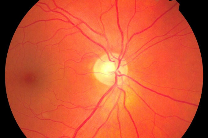 Unas 800.000 personas mayores de 65 años padecen degeneración macular asociada a la edad (DMAE) en España
