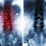 La cirugía de columna permite solucionar problemas como la hernia discal o la estenosis de canal