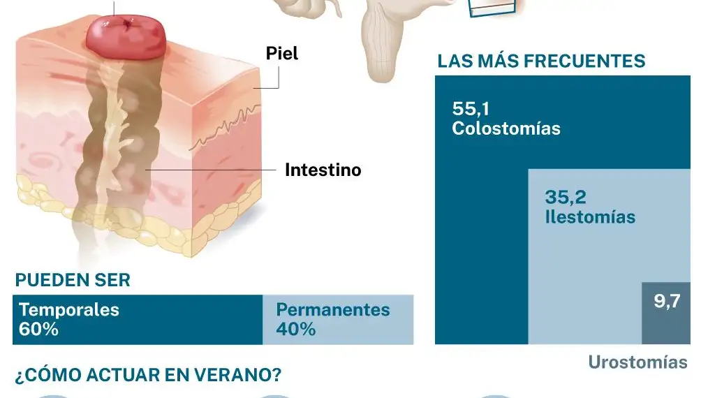 Ostomía y verano