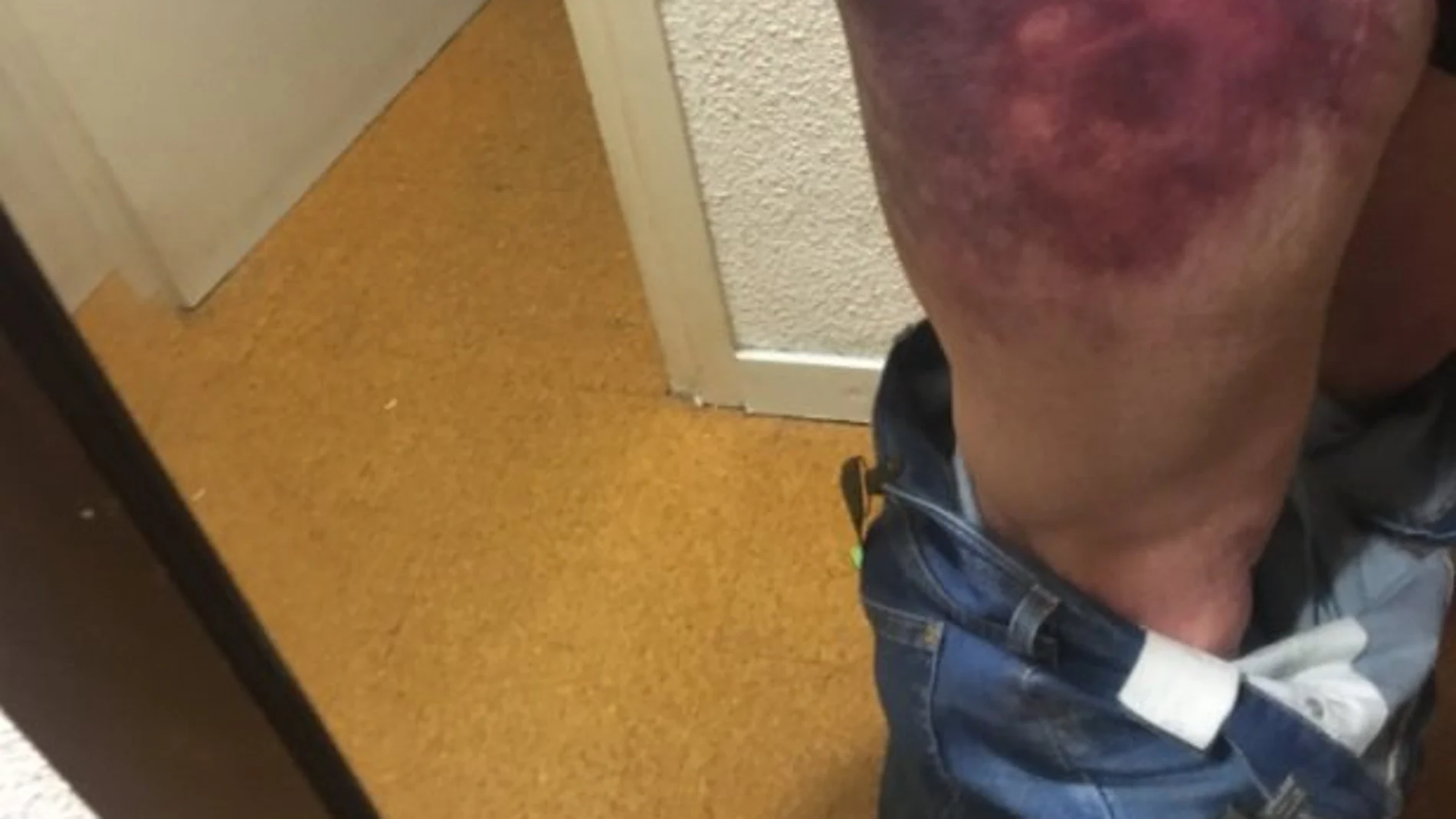 El actor mostró su herida en su perfil de Twitter