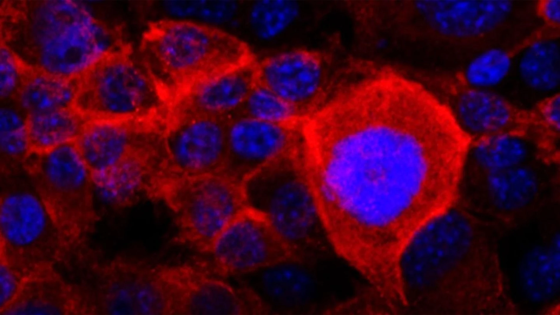Imagen microscópica de células cancerígenas