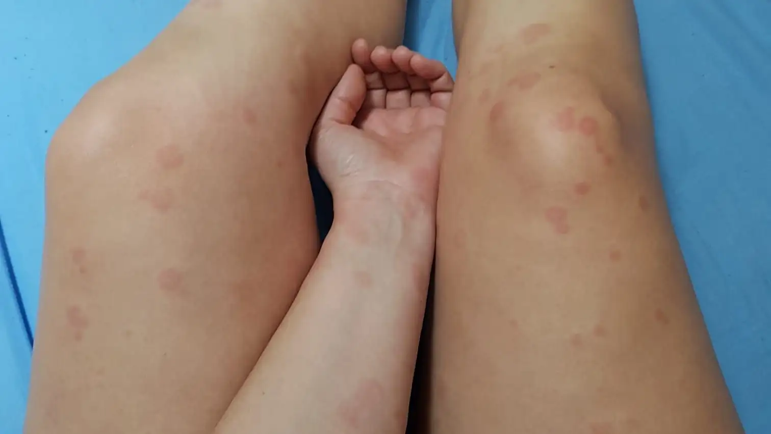 «No sé si podré dar el pecho a mi bebé por la urticaria por presión»