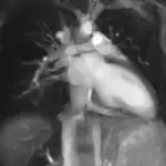 Imagen por resonancia magnética del latido de un corazón.