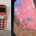 El cirujano jefe que lideró la operación, Skender Teljaku, reveló en Facebook que separaron el teléfono móvil en tres piezas