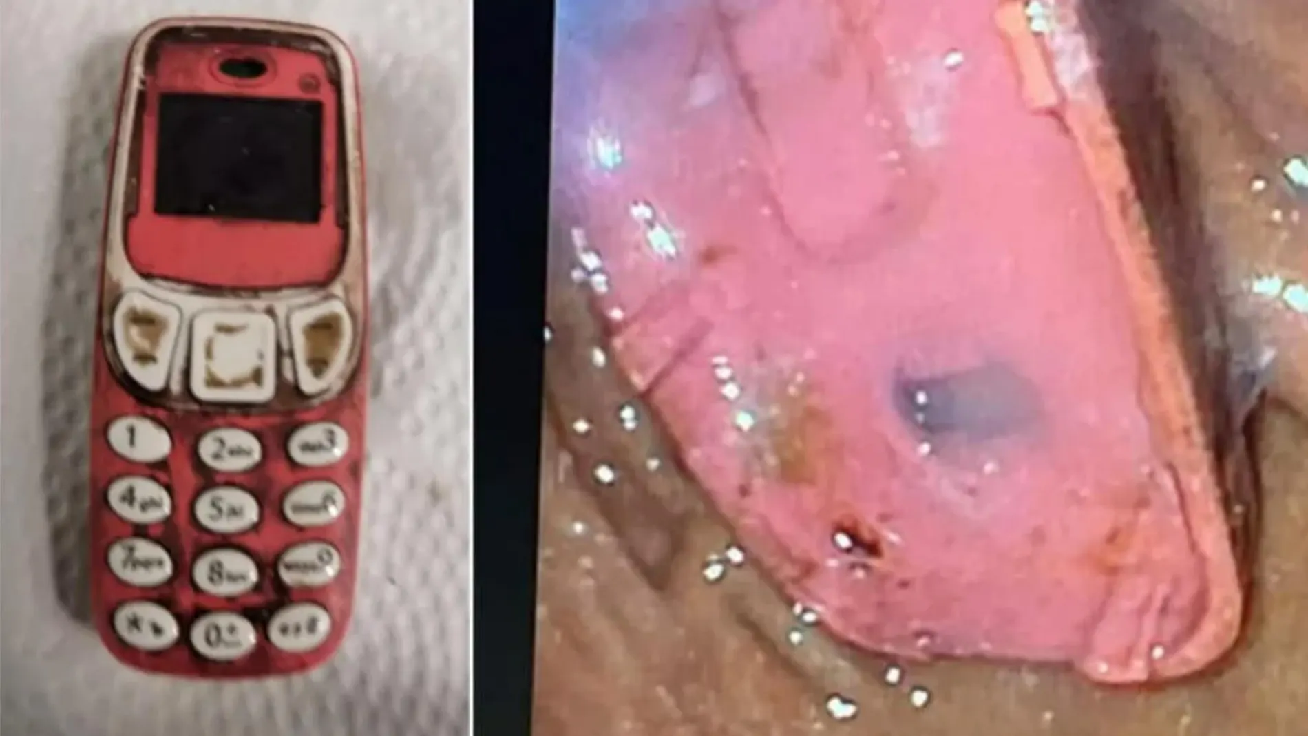 El cirujano jefe que lideró la operación, Skender Teljaku, reveló en Facebook que separaron el teléfono móvil en tres piezas