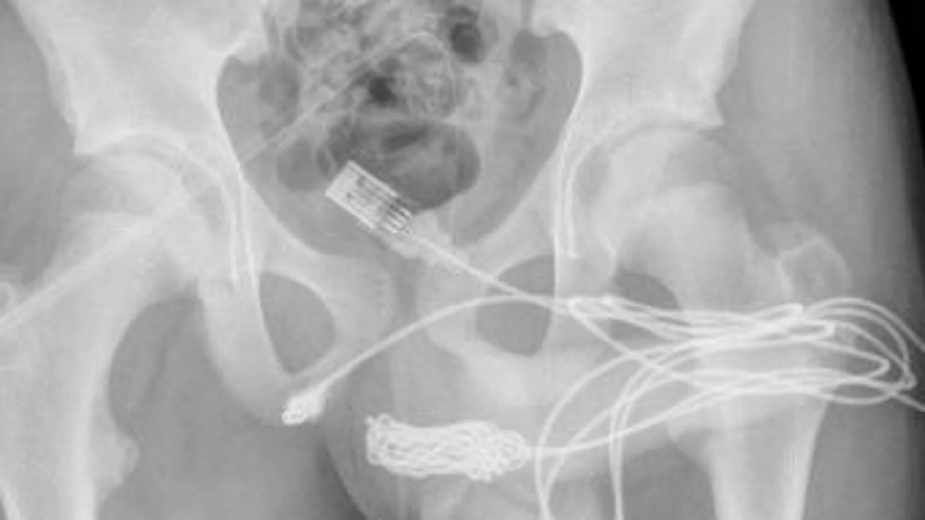 El niño no necesitó más tratamiento y fue dado de alta al día siguiente. Urology Case Reports