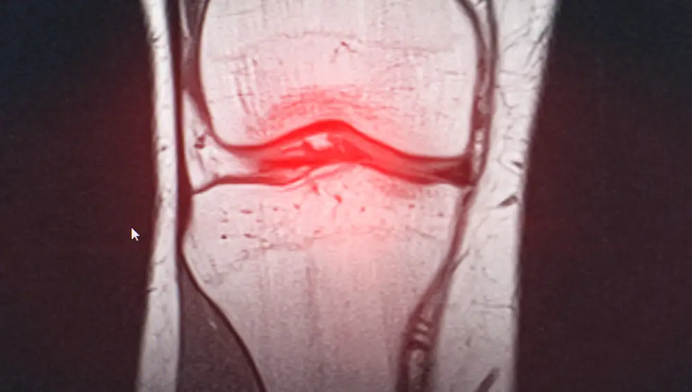 Artrosis radiografía rodilla