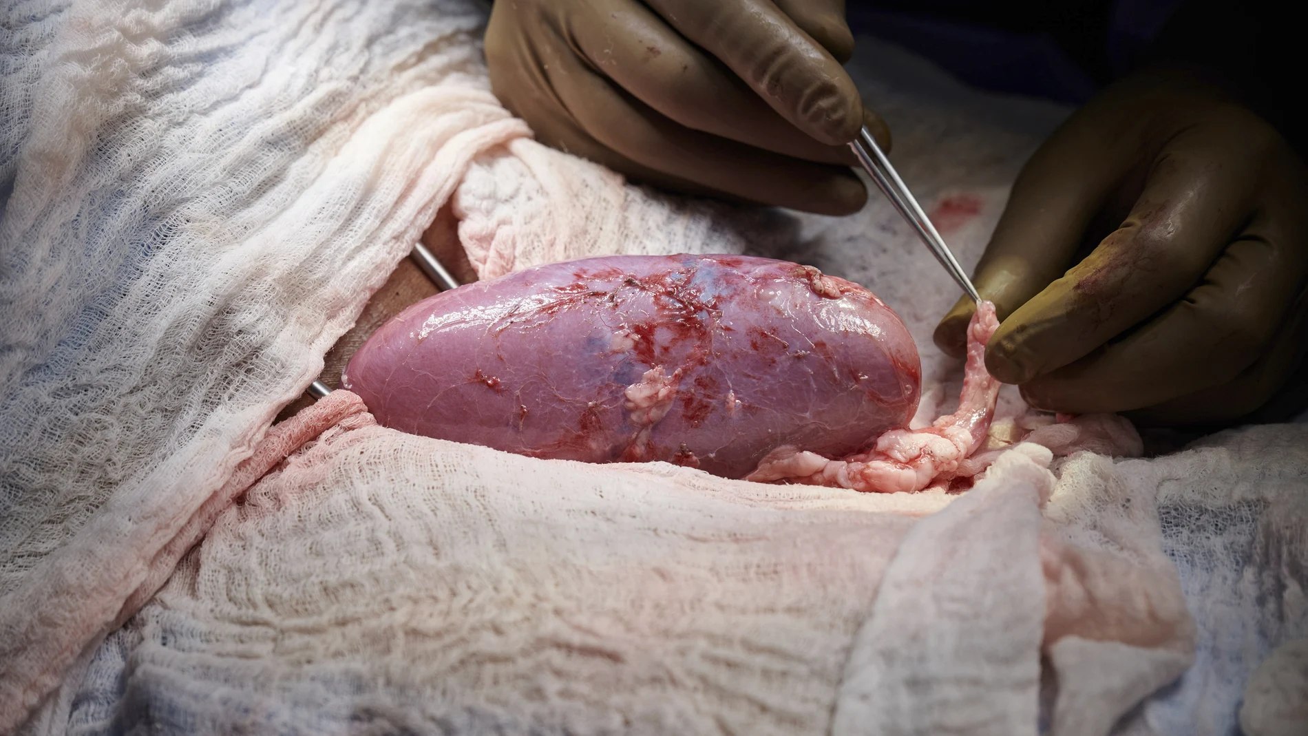 El riñón se encontraba en el exterior del cuerpo para poder observarlo