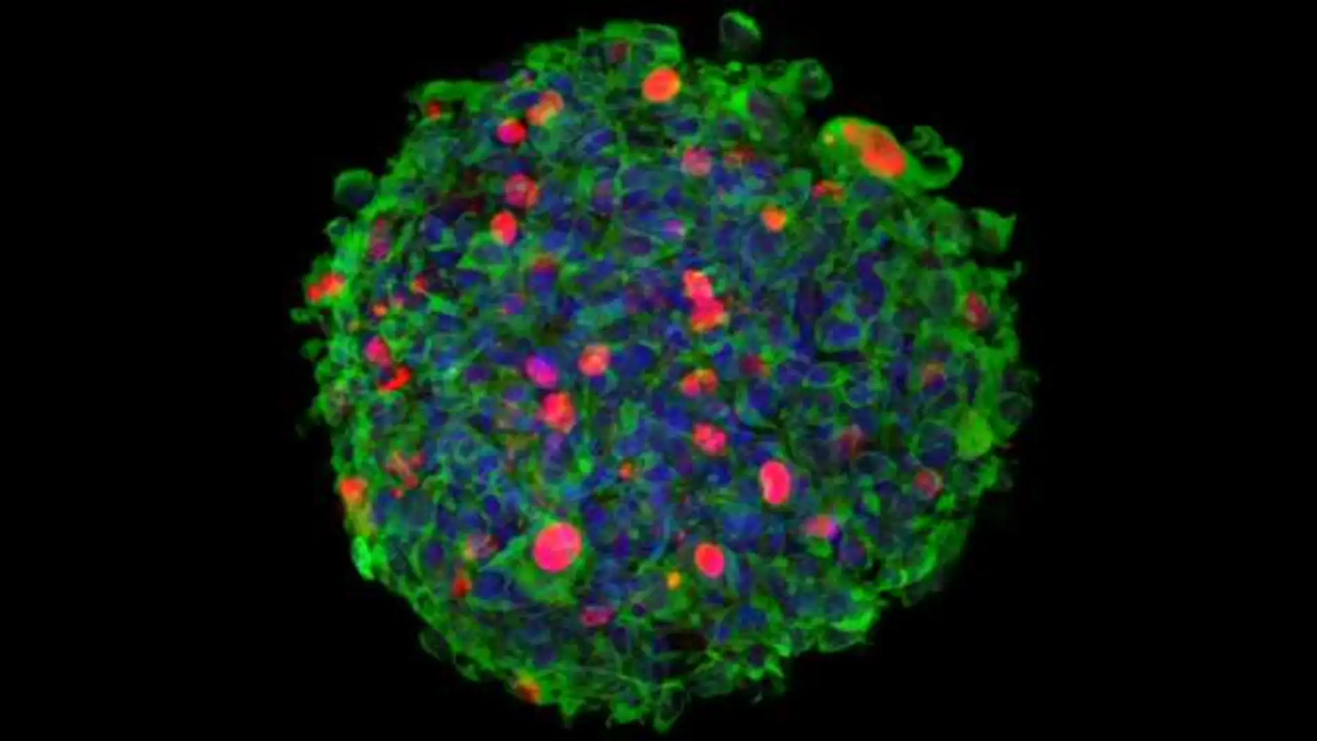Imagen 3D de inmunomicroscopía confocal de una neuroesfera originada por células madre aisladas de un paciente de glioblastoma (GSC), e infectadas por el parvovirus MVM (Minute Virus of Mice)