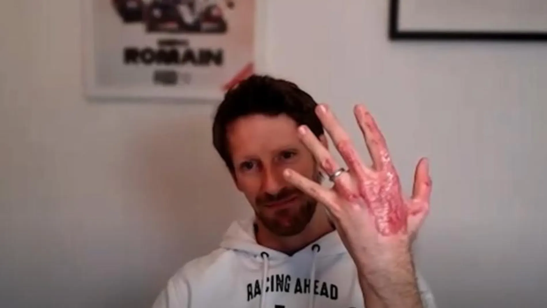 Romain Grosjean enseña el estado de su mano izquierda