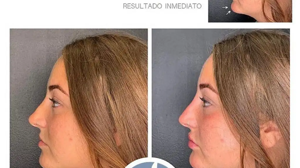 Rocío Flores, antes y después de algunos de sus retoques