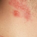 Aparición de ampollas debido a un herpes zoster
