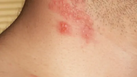 Aparición de ampollas debido a un herpes zoster