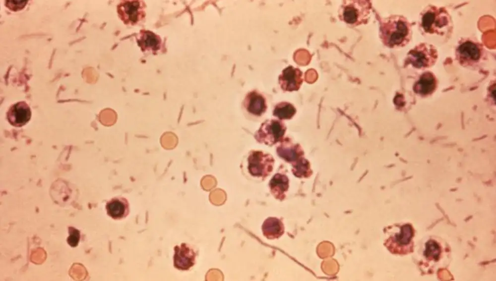 Microfotografía de heces en un paciente con shigelosis, que también se conoce como &quot;disentería por Shigella&quot; o &quot;disentería bacteriana&quot; | Dominio Público