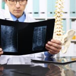 La osteoporosis no duele ni se presenta con ningún síntoma hasta que aparece una fractura por fragilidad