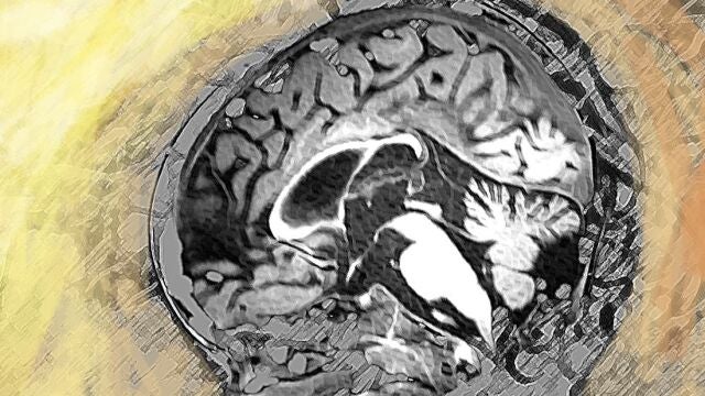 Cerebro con leucodistrofia