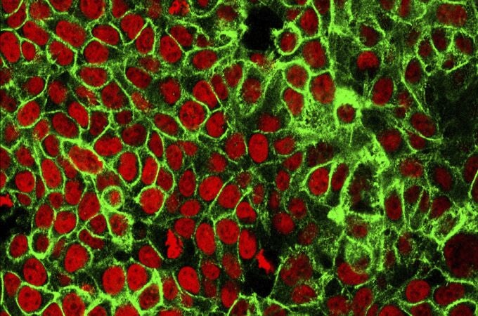 Imagen microscópica de células cancerígenas en el colon