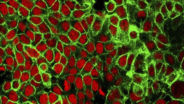 Imagen microscópica de células cancerígenas en el colon