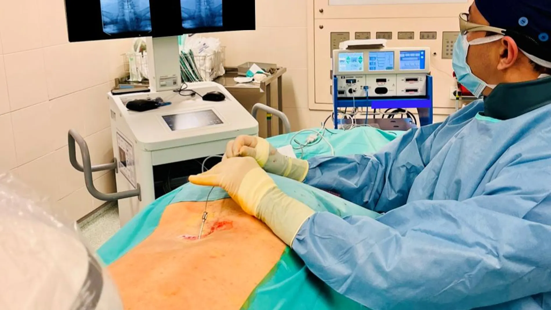 Una intervención quirúrgica para implantar el estimulador medular
