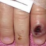 Fotografía del Centro Estadounidense de Control de las Enfermedades (CDC) en la que se aprecia el dedo de un niño infectado por la llamada viruela de mono
