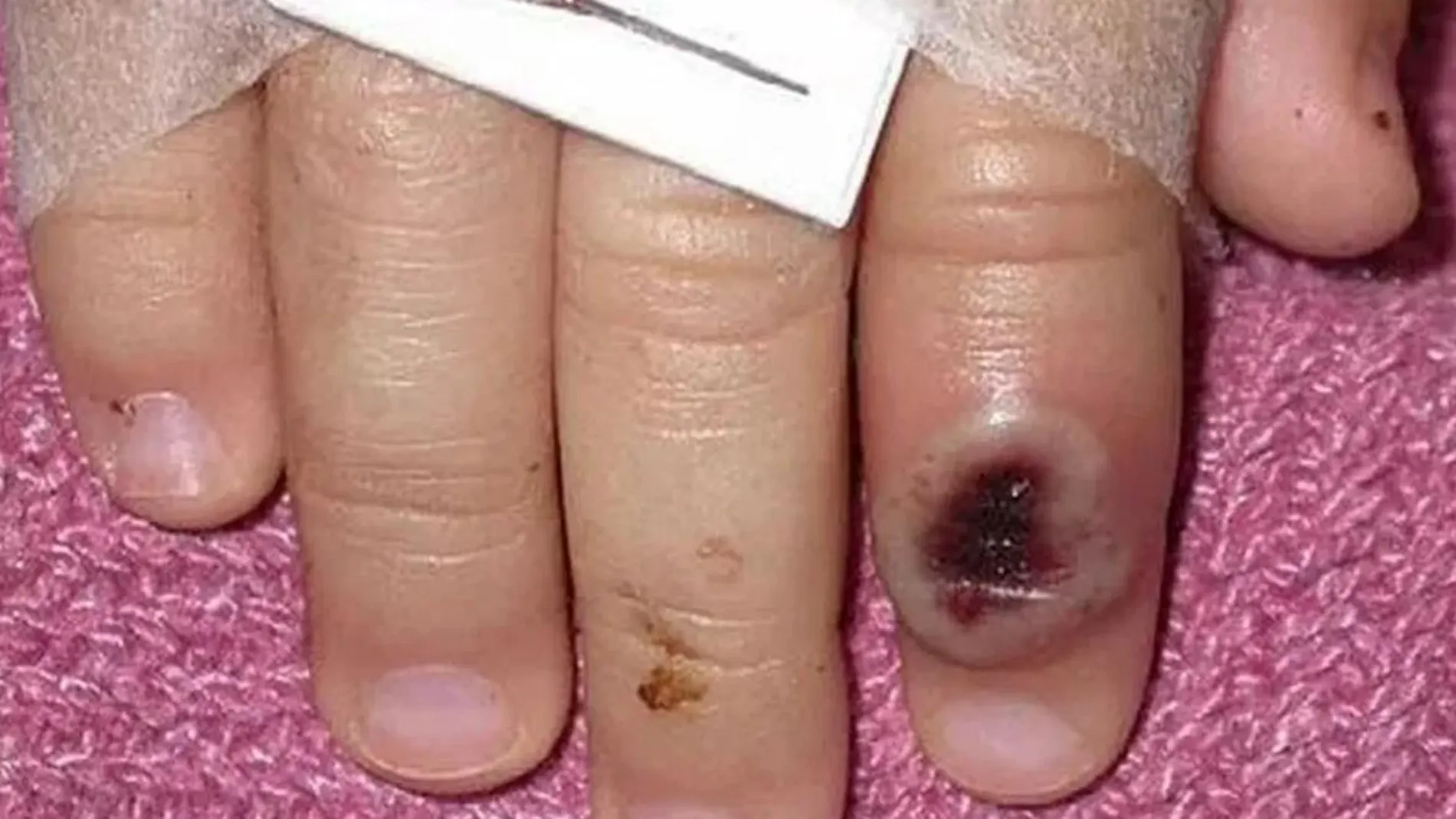 Fotografía del Centro Estadounidense de Control de las Enfermedades (CDC) en la que se aprecia el dedo de un niño infectado por la llamada viruela de mono