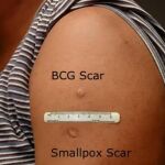 Diferencias entre la cicatriz que deja la vacuna de la tuberculosis BCG (arriba) y la de la vacuna de la viruela (debajo)
