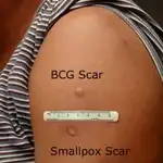 Diferencias entre la cicatriz que deja la vacuna de la tuberculosis BCG (arriba) y la de la vacuna de la viruela (debajo)