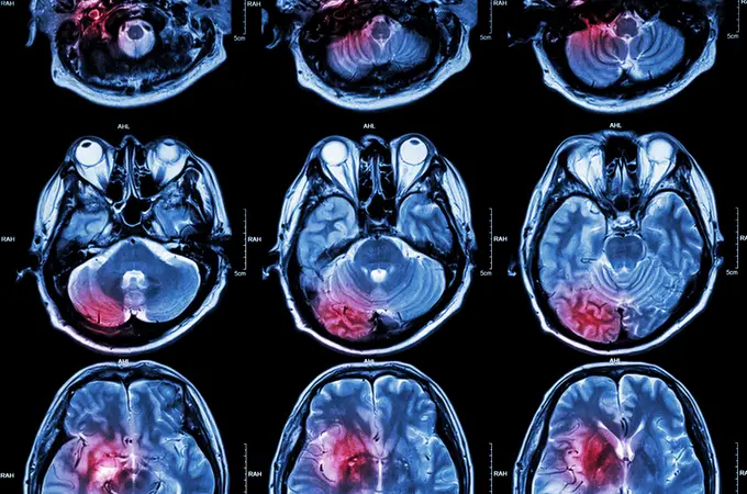 Una nueva prueba para el diagnóstico precoz del alzhéimer logra una efectividad del 98%