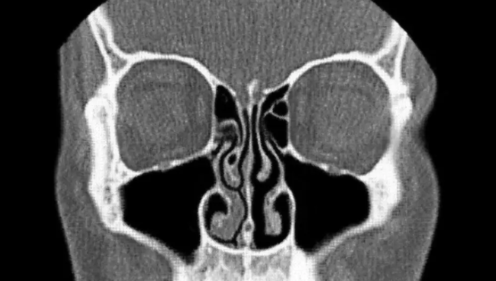Una tomografía computarizada que muestra evidencia del ciclo nasal. La vía aérea más abierta está a la derecha de la imagen, mientras los cornetes hinchados congestionan la izquierda | Fuente: Wikimedia