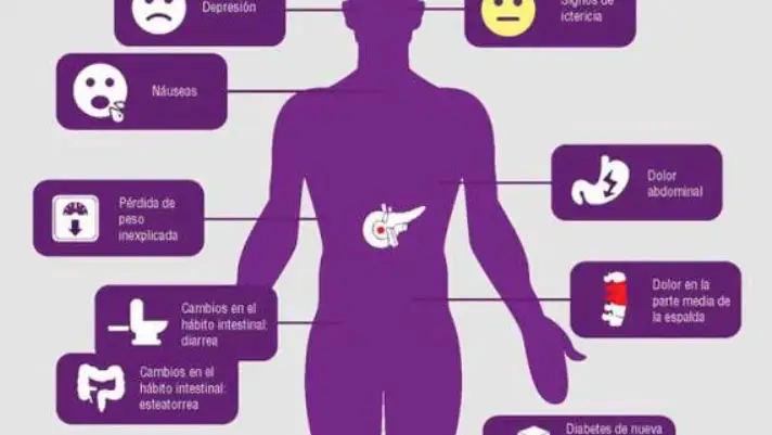 Diez signos a tener en cuenta a la hora de diagnosticar el cáncer de páncreas