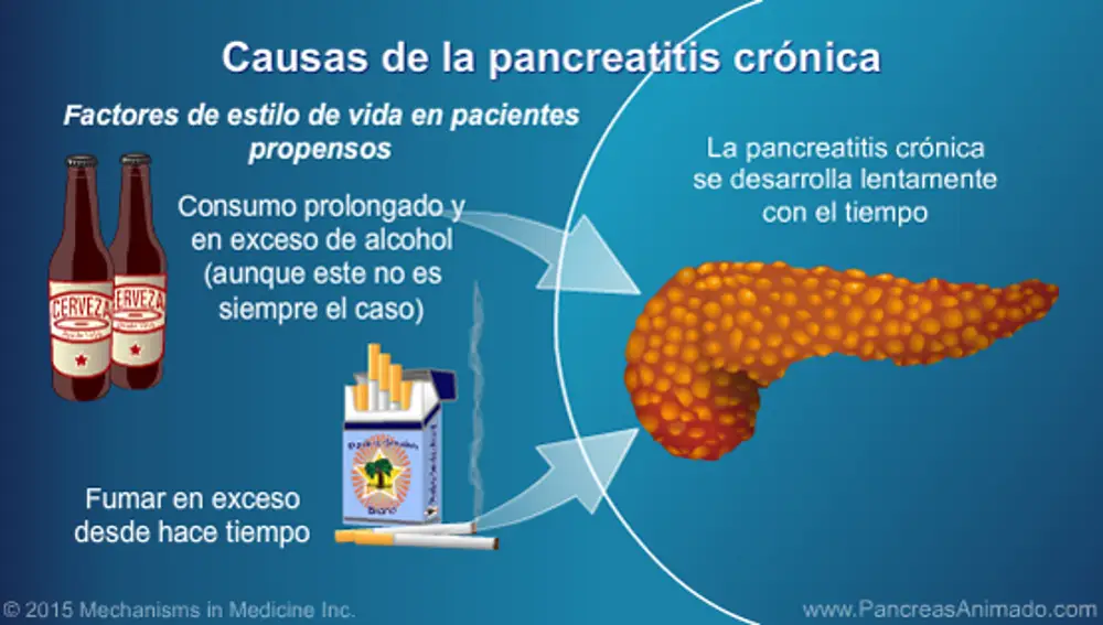 La pancreatitis crónica suele ser uno de los factores de riesgo para la aparición del cáncer de páncreas