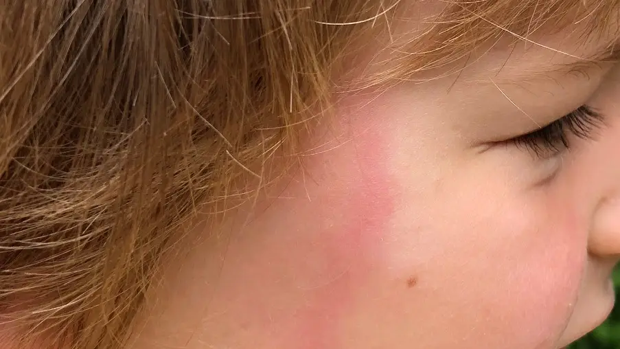 Niño con la enfermedad de Lyme