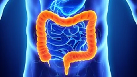 El cáncer colorrectal es uno de los tumores más frecuentes a nivel mundial