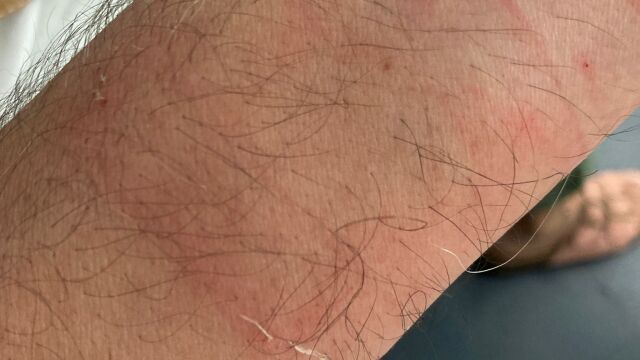 Heridas causadas por el robo de un reloj En Les Corts