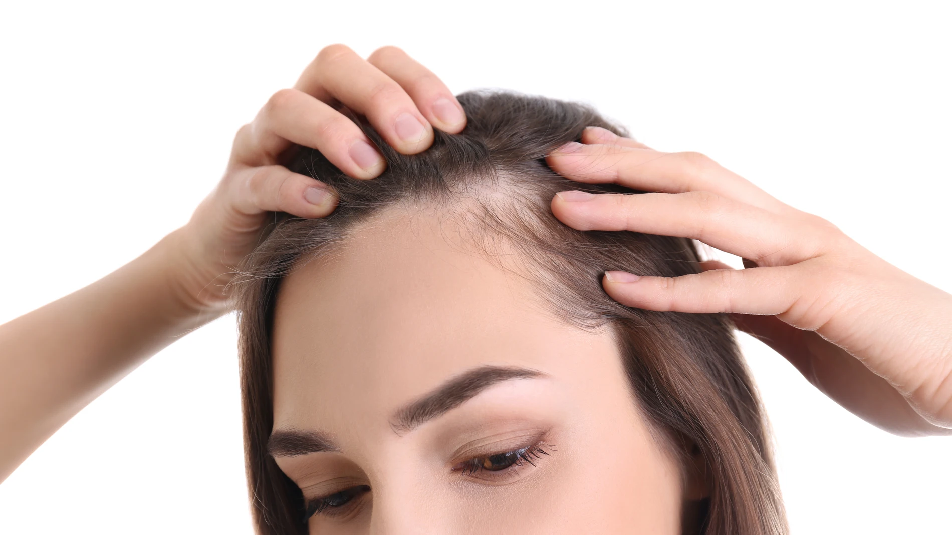 El efluvio telógeno es una de las causas más frecuentes de alopecia