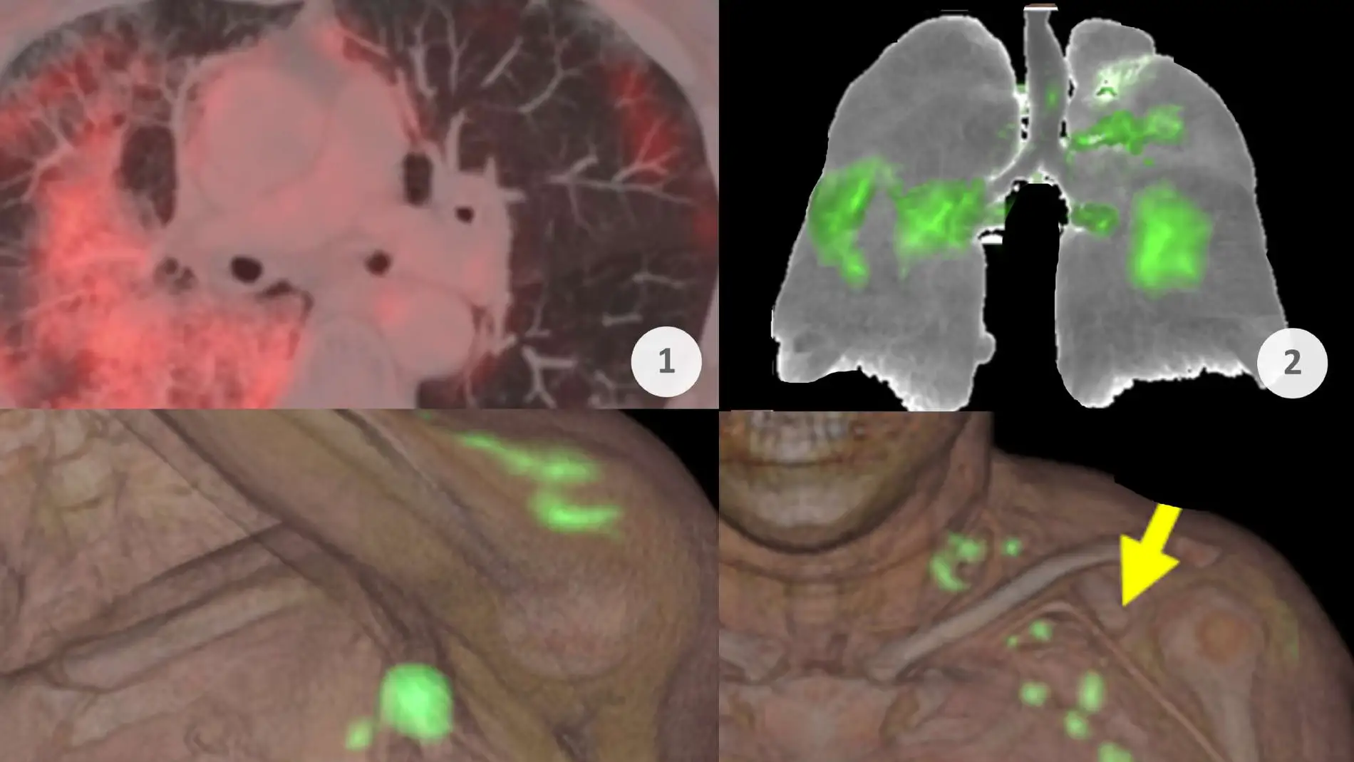 Retrato de la pandemia vista a través de un PET