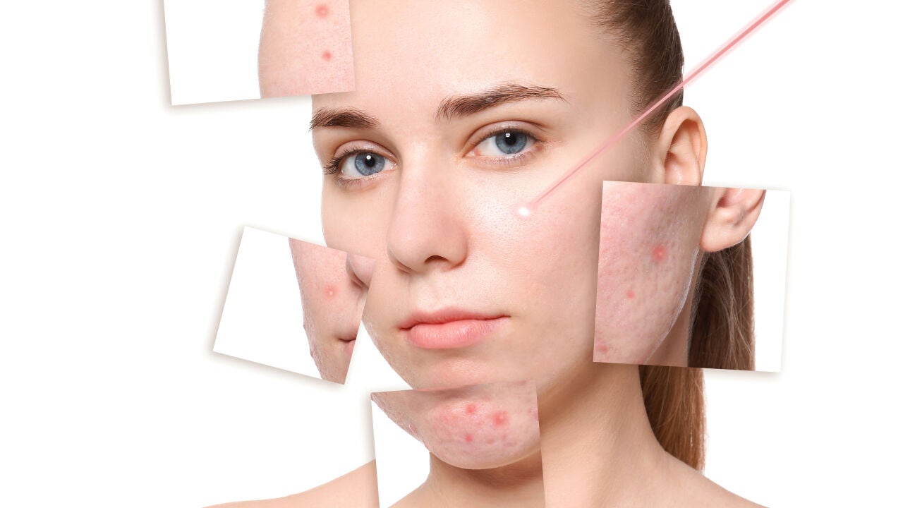 Precio Roacutan Mexico