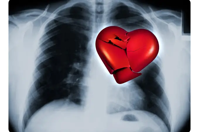 No es un infarto, su corazón puede llegar a «romperse» 